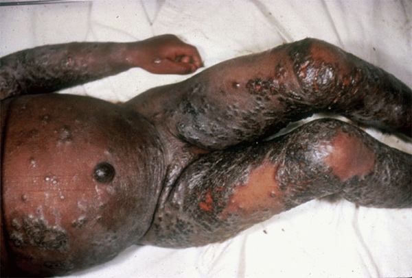 Eczema Vaccinatum Body John M Leedom